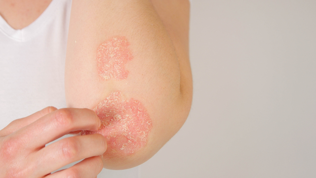 Psoriasis vs. Eczema: What's the Difference, and How Should You Care for Your Skin?