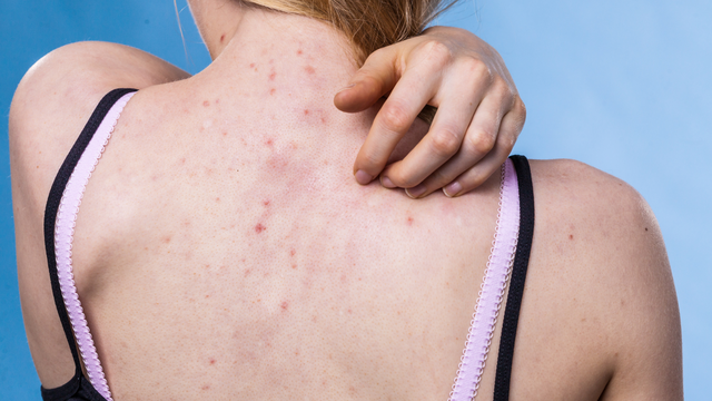 Beat Body Acne This Summer: Simple Tips to Keep Your Skin Clear