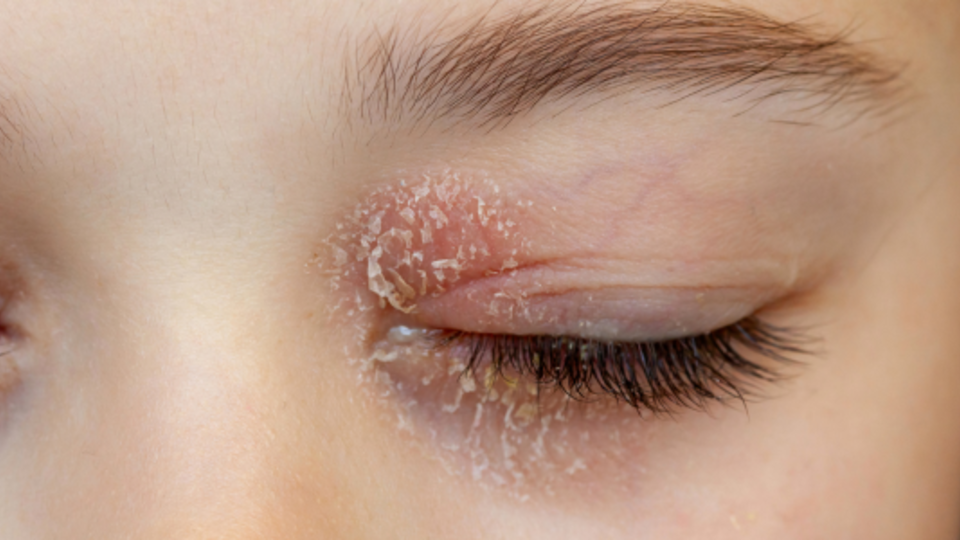 Your Guide To Managing & Treating Eyelid Dermatitis